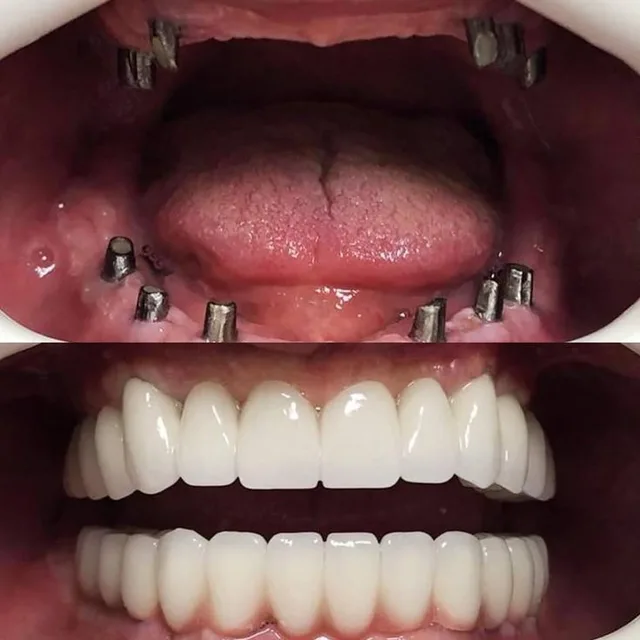 Before and after dental transformation 1