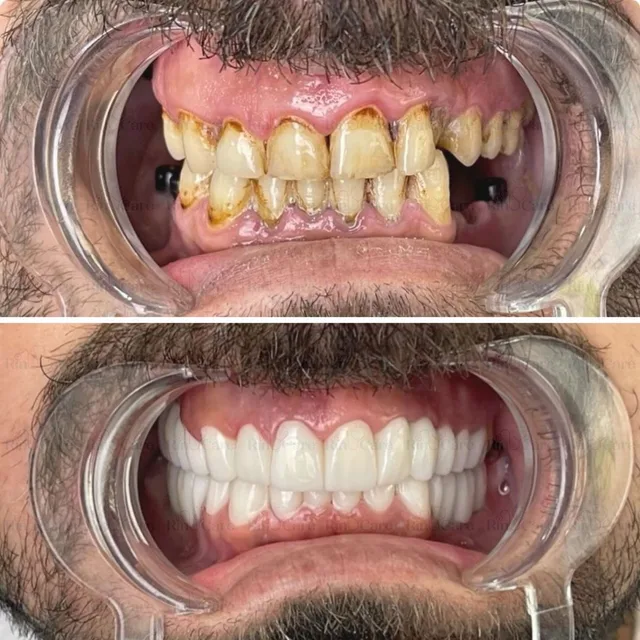 Before and after dental transformation 4